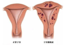 经期三大警示信号：警惕子宫腺肌症悄然而至